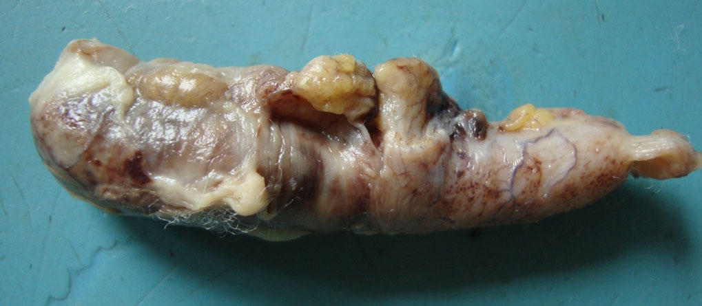 Acute Appendicitis