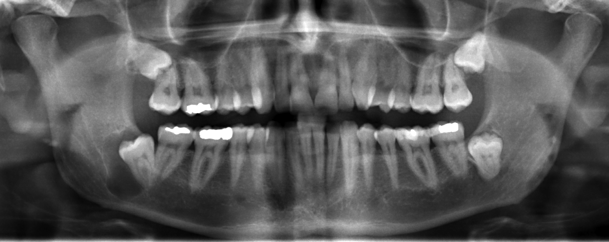 Dentigerous Cyst