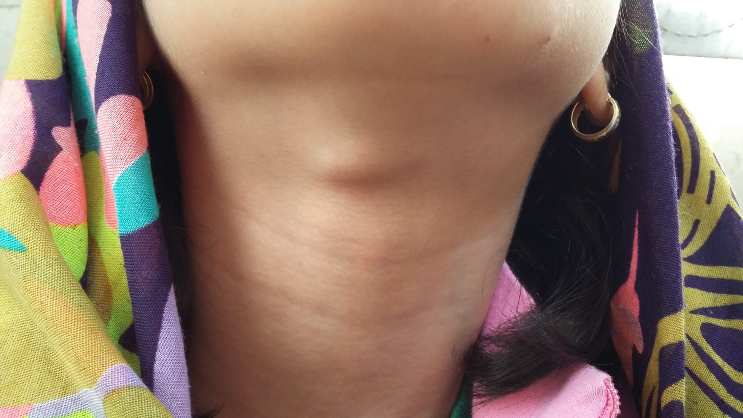 Thyroglossal Fistula