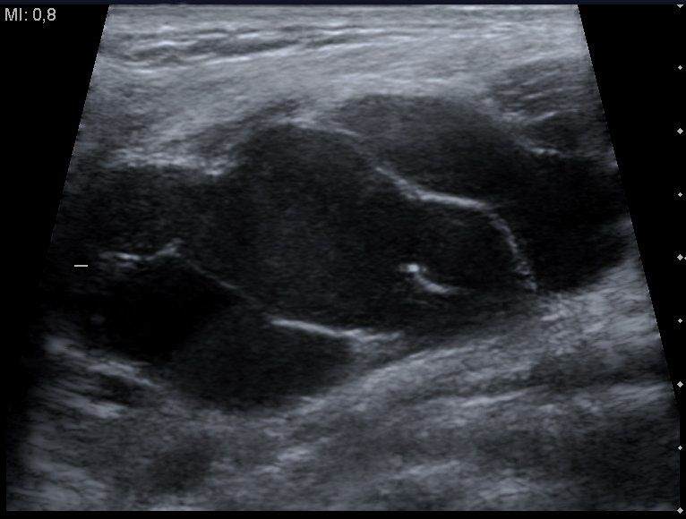 Cystic Hygroma